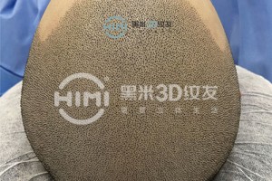 头顶脱发怎么办？黑米3D纹发帮助头顶脱发朋友挽回形象